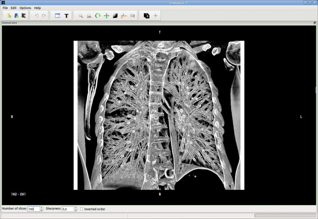 Скриншот 4 программы InVesalius 3